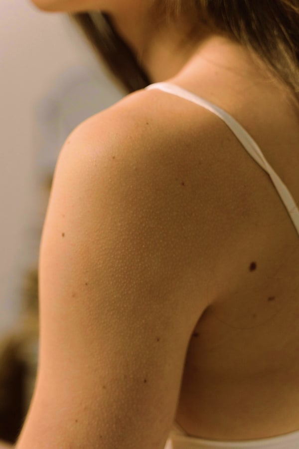 exerese chirurgicale chirurgie dermatologique paris dr alexandre duhoux chirurgien medecine esthetique et plastique chirurgie reparatrice antony paris