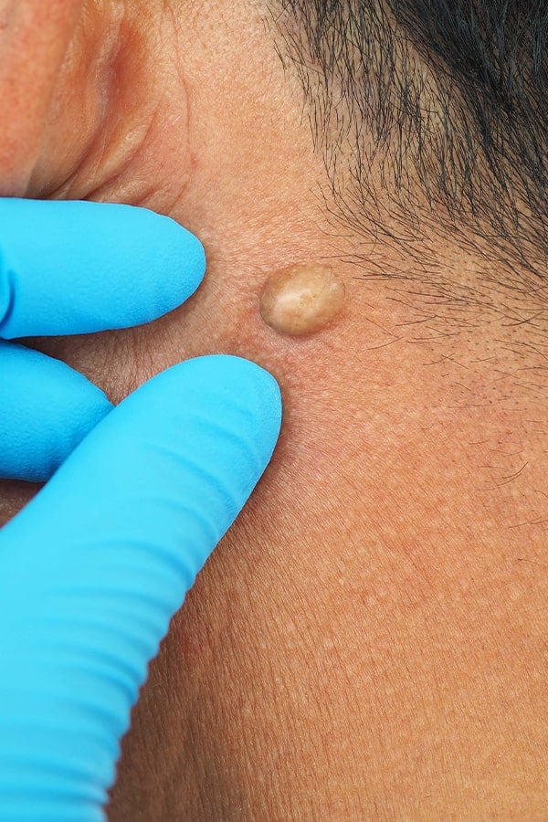 exerese kyste sebace loupe chirurgie dermatologique paris dr alexandre duhoux chirurgien medecine esthetique et plastique chirurgie reparatrice antony paris exerese kyste sebace loupe chirurgie dermatologique paris dr alexandre duhoux chirurgien medecine esthetique et plastique chirurgie reparatrice antony paris