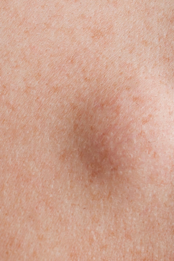 exerese lipome chirurgie dermatologique paris dr duhoux plasticien chirurgie medecine esthetique reparatrice antony paris exerese lipome chirurgie dermatologique paris dr duhoux plasticien chirurgie medecine esthetique reparatrice antony paris