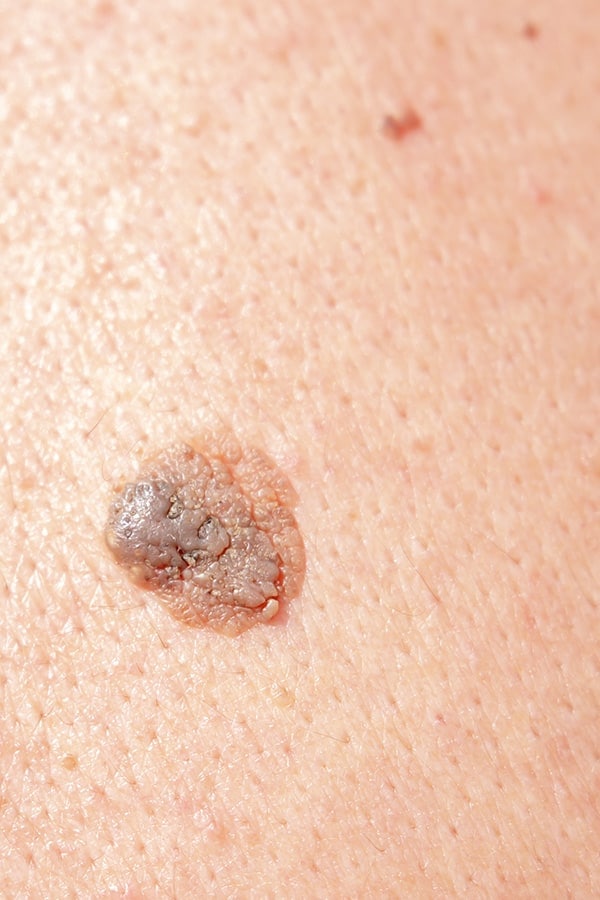 exerese tumeur cutanee chirurgie dermatologique paris dr duhoux plasticien chirurgie medecine esthetique reparatrice antony paris exerese tumeur cutanee chirurgie dermatologique paris dr duhoux plasticien chirurgie medecine esthetique reparatrice antony paris