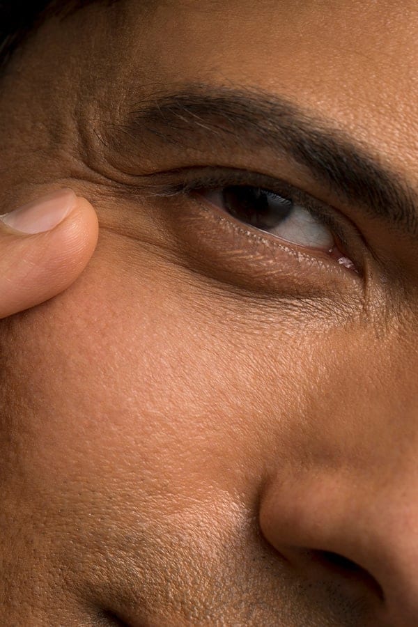 injeciton botox patte oie medecine esthetique paris chirurgie reparatrice dr alexandre duhoux medecine chirurgien esthetique et plastique antony paris injeciton botox patte oie medecine esthetique paris chirurgie reparatrice dr alexandre duhoux medecine chirurgien esthetique et plastique antony paris