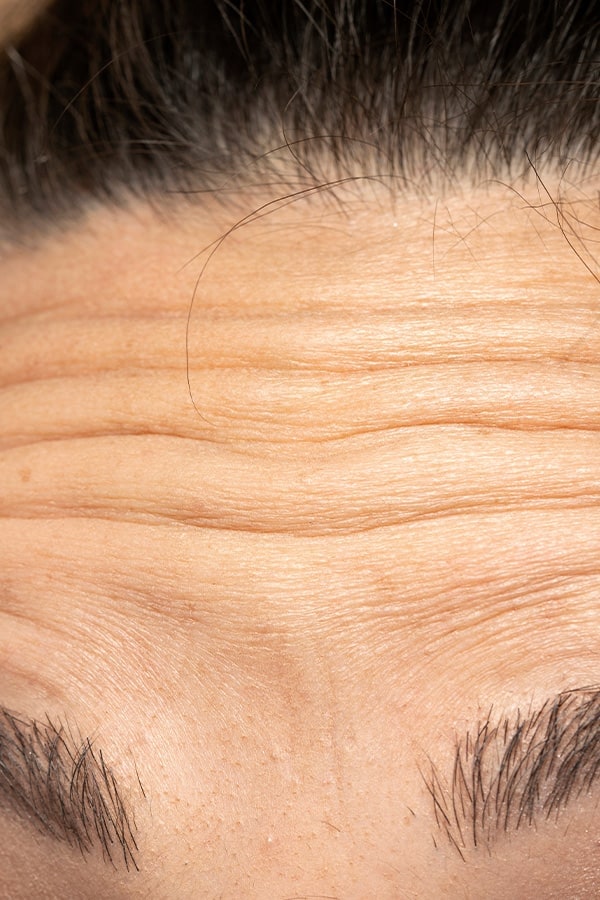 injection botox front medecine esthetique paris dr duhoux plasticien chirurgie medecine esthetique reparatrice antony paris