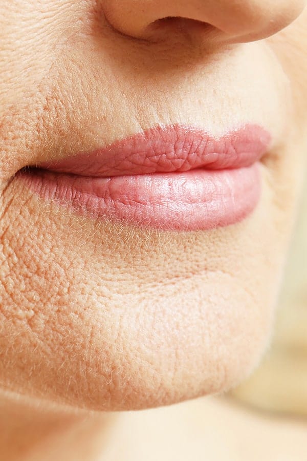 injection botox pli amertume levres medecine esthetique paris dr alexandre duhoux chirurgien medecine esthetique et plastique chirurgie reparatrice antony paris injection botox pli amertume levres medecine esthetique paris dr alexandre duhoux chirurgien medecine esthetique et plastique chirurgie reparatrice antony paris