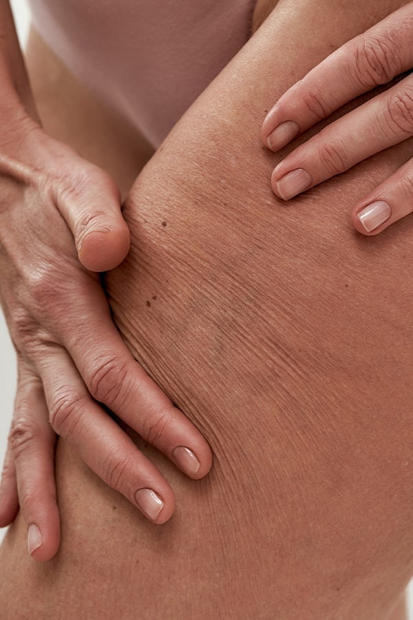 liposuccion cuisses avant apres chirurgie esthetique corps dr alexandre duhoux chirurgien medecine esthetique et plastique chirurgie reparatrice antony paris liposuccion cuisses avant apres chirurgie esthetique corps dr alexandre duhoux chirurgien medecine esthetique et plastique chirurgie reparatrice antony paris