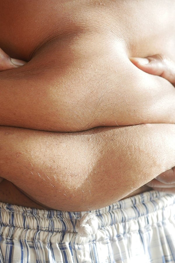 liposuccion homme prix paris avant apres chirurgie esthetique corps dr duhoux chirurgien medecine esthetique et plastique chirurgie reparatrice antony paris