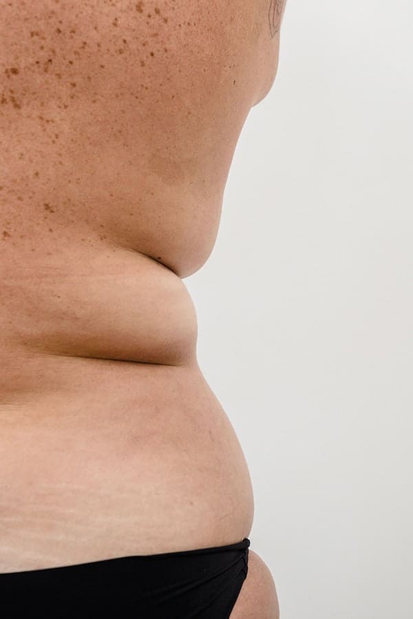 liposuccion poignees amour avant apres prix chirurgie esthetique corps medecine esthetique dr alexandre duhoux chirurgien plastique reconstructrice et esthetique antony paris liposuccion poignees amour avant apres prix chirurgie esthetique corps medecine esthetique dr alexandre duhoux chirurgien plastique reconstructrice et esthetique antony paris