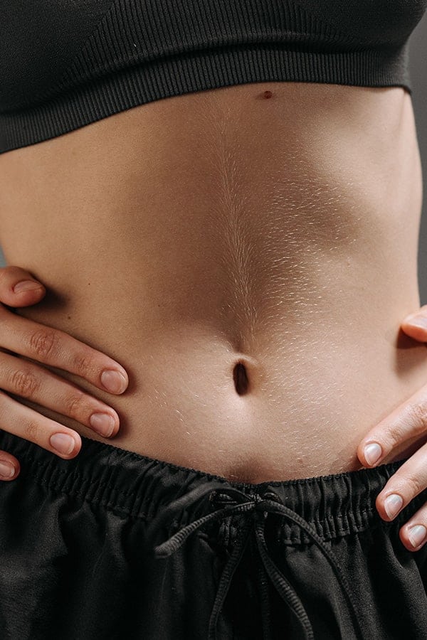 ombilicoplastie avant apres technique paris chirurgie esthetique corps dr alexandre duhoux medecine plasticien chirurgien esthetique antony paris