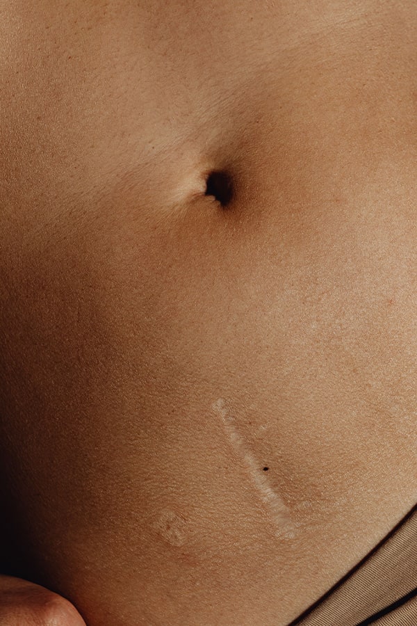 reprise cicatrice chirurgie dermatologique paris chirurgie reparatrice dr duhoux medecine chirurgien esthetique et plastique antony paris