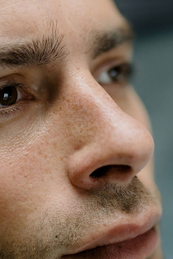 rhinoplastie homme paris avant apres chirurgie du nez paris medecine esthetique dr alexandre duhoux chirurgien plastique reconstructrice et esthetique antony paris