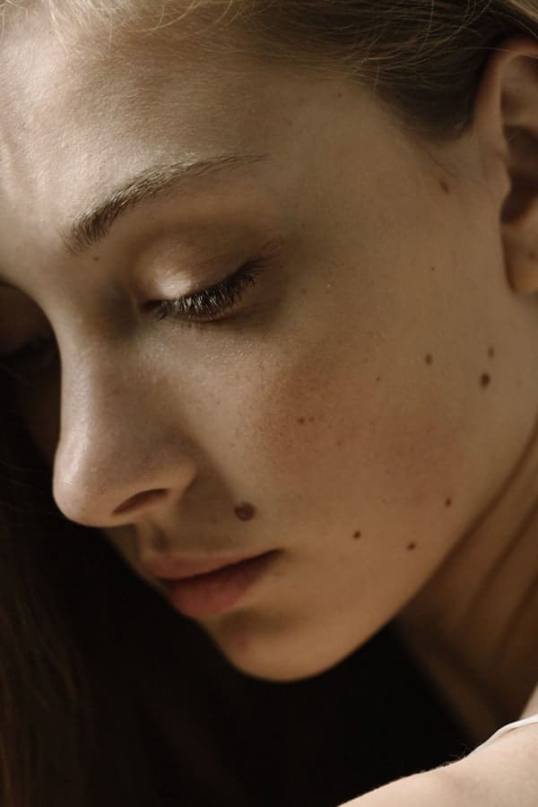 rhinoplastie post traumatique paris chirurgie du nez paris chirurgie reparatrice dr duhoux medecine chirurgien esthetique et plastique antony paris
